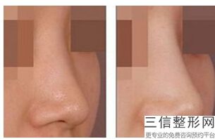 郑州鼻部整形多少钱，郑州做鼻子多少钱