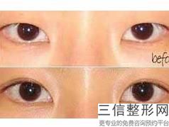 郑州激光祛痘的医院，郑州美眼医疗美容中心