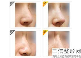 郑州哪家医院隆鼻好，郑州鼻部整形哪家好