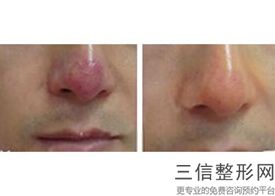 郑州哪家医院隆鼻好，郑州鼻部整形哪家好