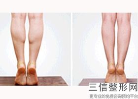 终于做了手臂吸脂减肥 大家看效果明显吗，手臂环吸抽脂会反弹吗