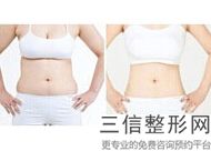 终于做了手臂吸脂减肥 大家看效果明显吗，手臂环吸抽脂会反弹吗