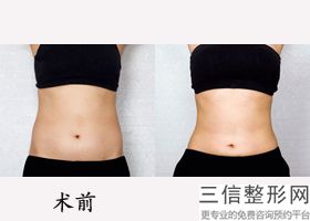 终于做了手臂吸脂减肥 大家看效果明显吗，手臂吸脂好后悔