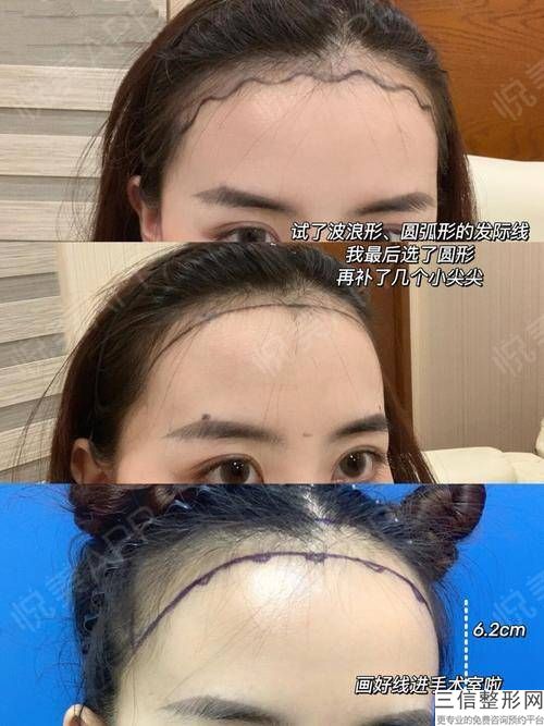 种的胡子会不会生长，胡子可以种植头发上吗
