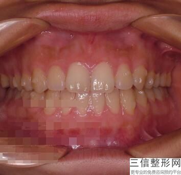 种植体靠近邻牙牙根有危险吗，种植体碰到邻牙根有什么后果