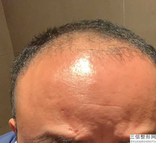 种植头发效果可靠吗,种植头发有用么