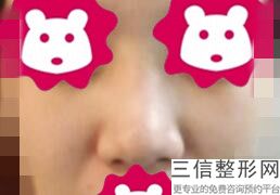 注射隆鼻除了玻尿酸还会用什么材料，打玻尿酸隆鼻有副作用吗