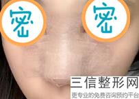 注射隆鼻怎么样，注射隆鼻有哪里好