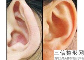 自体脂肪丰耳垂对比照，自体丰耳垂维持多久