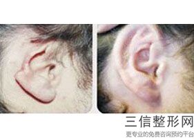 自体脂肪丰耳垂对比照，自体丰耳垂维持多久