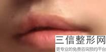 嘴唇变薄手术多少钱,厚唇改薄大概多少钱