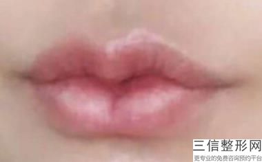 嘴唇打玻尿酸会改善唇纹吗，打玻尿酸可以改善唇纹吗