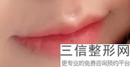 嘴唇整形术,嘴唇整形可以整成什么形状