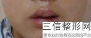 嘴角两边凹用什么填充良好,嘴唇能脂肪填充吗
