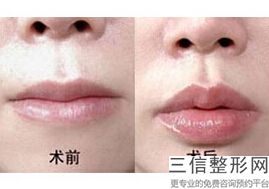 嘴角两边凹用什么填充良好,嘴唇能脂肪填充吗