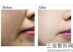做热玛吉大概要多少钱,热玛吉美容仪器多少钱