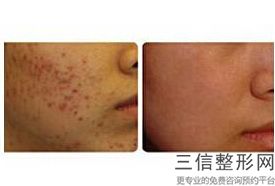 做热玛吉大概要多少钱,热玛吉美容仪器多少钱