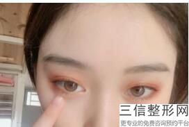 做上眼睑下垂手术需要注意什么，做完上睑下垂手术该注意什么