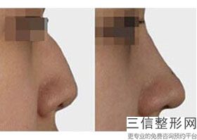 2022宁波隆鼻整形医院排行前十口碑推荐！宁波壹加壹美容整形医院排名靠前