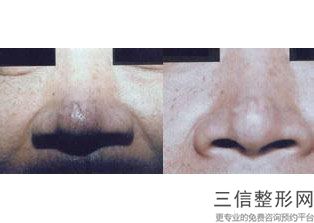 北京隆鼻医院排行榜！北京煤医医疗美容医院实力入围