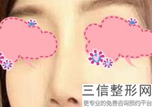 长沙隆鼻整形医院哪家好！长沙爱思特医疗美容医院实力超强