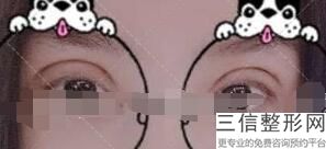 长沙双眼皮整形医院排名前五！长沙美沃医疗美容门诊部实力上榜