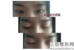 成都割双眼皮医院排名前十！成都米兰柏羽整形医院锁定前十