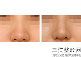 国内隆鼻医院排名！锁定前十