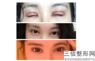 合肥做双眼皮好的整形医院有哪些！合肥源森美容整形外科诊所实力上榜