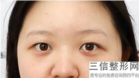济南双眼皮整形医生排名前五名单汇总！口碑良好
