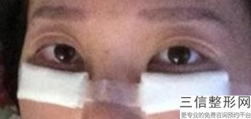 济南双眼皮整形医生排名前五名单汇总！口碑良好