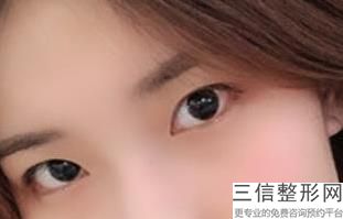 济南双眼皮整形医生排名前五名单汇总！口碑良好