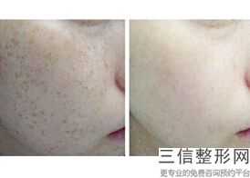 南京哪家整形医院做拉皮好！遥遥领先
