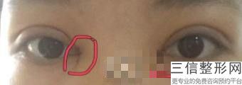 南宁去眼袋整形美容医院排名榜！南宁市人民医院整形美容外科锁定前十