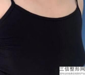 青岛隆胸整形医院哪家好!青岛爱美丽整形医院排名靠前