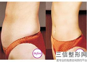上海动氧瘦腹部医院排名!上海名格医疗整形美容门诊部位列前十