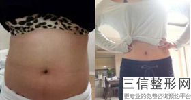 上海隔空溶脂瘦手臂医院排名！上海瑞阳整形美容医院锁定前十