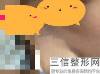 上海华美做鼻子的医生谁好!张朋医生口碑良好