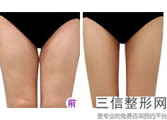 深圳射频溶脂瘦手臂医院哪家好！口碑良好