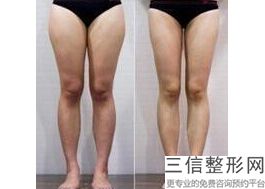 深圳射频溶脂瘦手臂医院哪家好！口碑良好