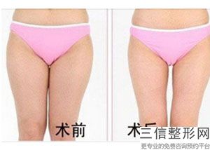 深圳射频溶脂瘦手臂医院哪家好！口碑良好