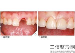 深圳种植牙医院排名!实力上榜
