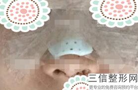 沈阳鹰钩鼻矫正医院排名！沈阳憬颜愫医疗整形遥遥领先