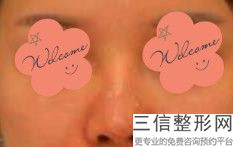 苏州隆鼻整形医院排行榜前十强!苏州美莱美容医院实力上榜