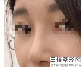 台州鼻部整形医院排名前十！台州温岭美诺整形医院位列前十