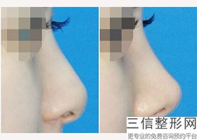 台州鼻部整形医院排名前十！台州温岭美诺整形医院位列前十