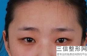 乌鲁木齐比较好的去眼袋整形机构排名！乌鲁木齐伊丽莎白整形美容医院首次上榜