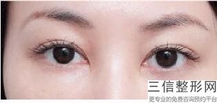 西安割双眼皮医院排行前十！西安米兰柏羽医疗美容医院口碑良好