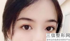 西安割双眼皮医院排行前十！西安米兰柏羽医疗美容医院口碑良好