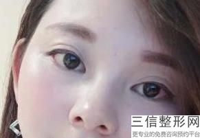 西安割双眼皮医院排行前十！西安米兰柏羽医疗美容医院口碑良好